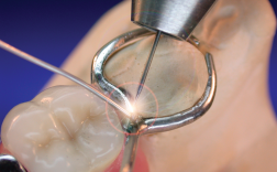 repair of broken clasp