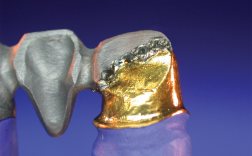 cast bridge element to Captek or electroformed coping