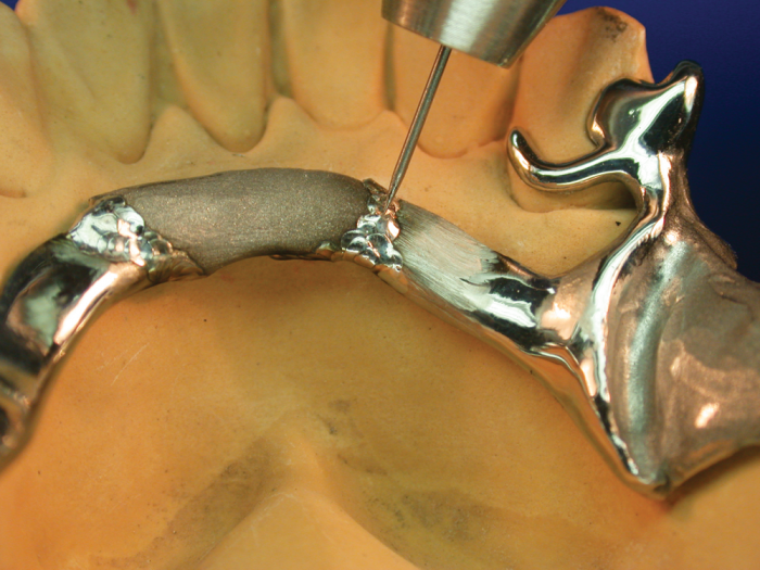 repair of broken sublingual bar